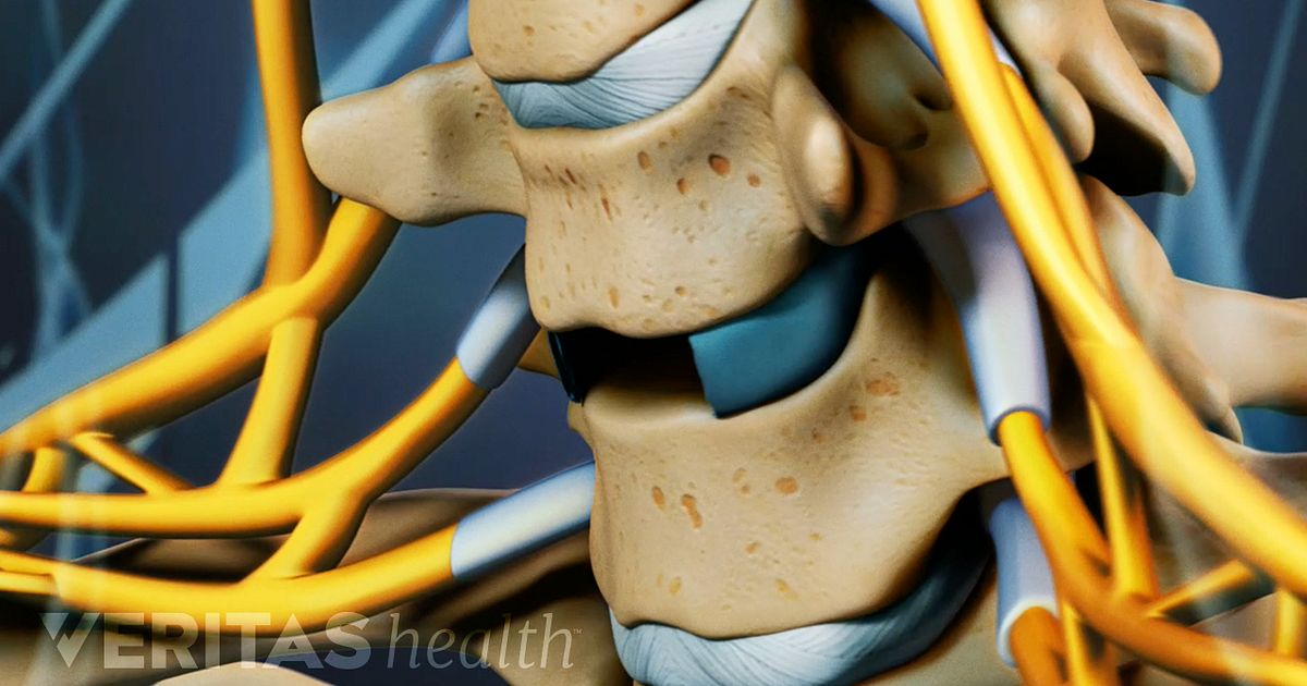 Decompression Surgery Definition | Back Pain and Neck Pain Medical Glossary