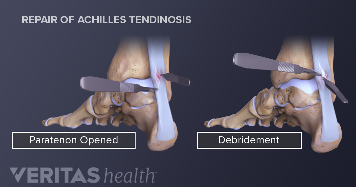 right achilles tendonitis