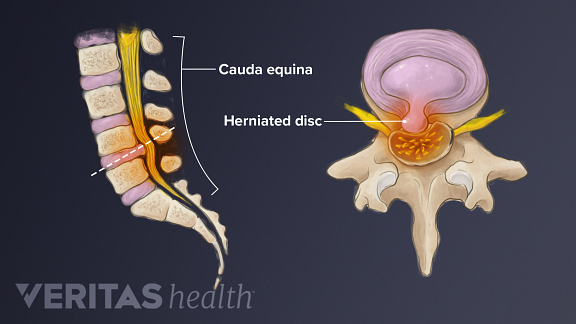 Profile of cauda equina. Anterior view of vertebrae with herniated disc.