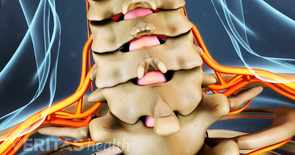 Conservative Treatment for a Cervical Herniated Disc