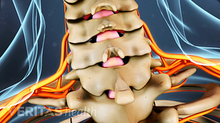 Cervical Herniated Disc