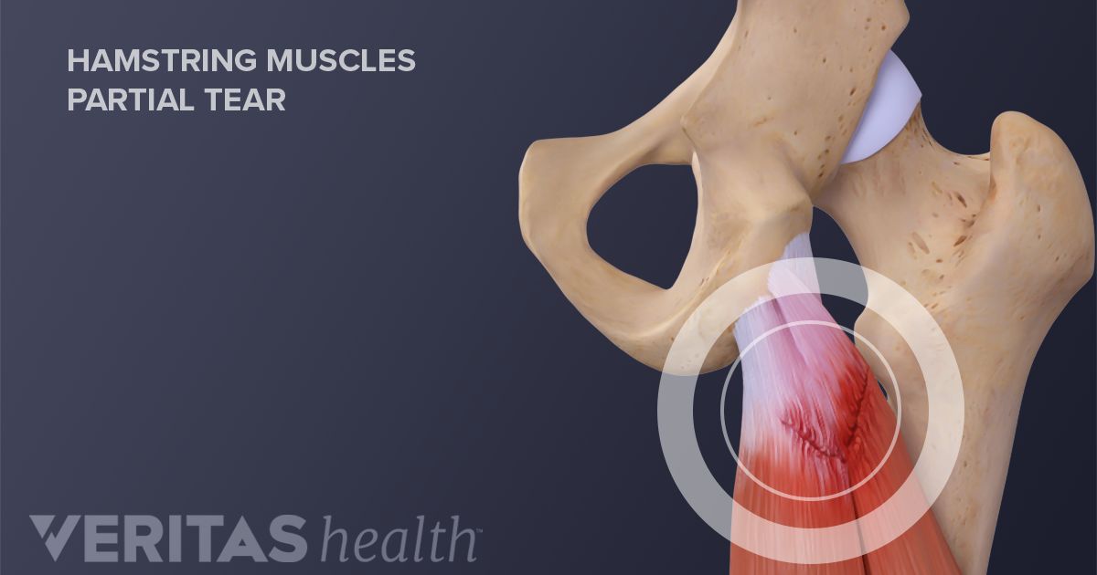 Acute Hamstring Tears   Adult Hamstring Muscles Partial Tear 