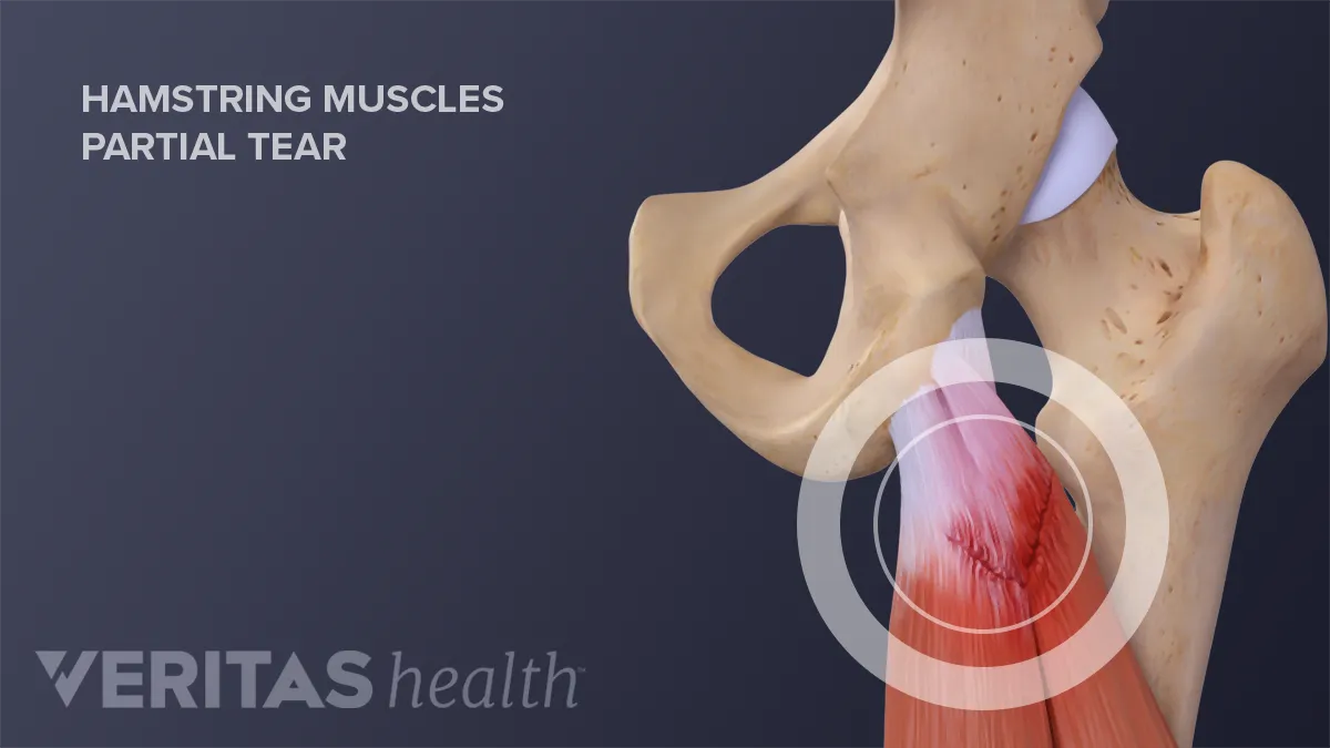 Hamstring Muscle Injuries - OrthoInfo - AAOS