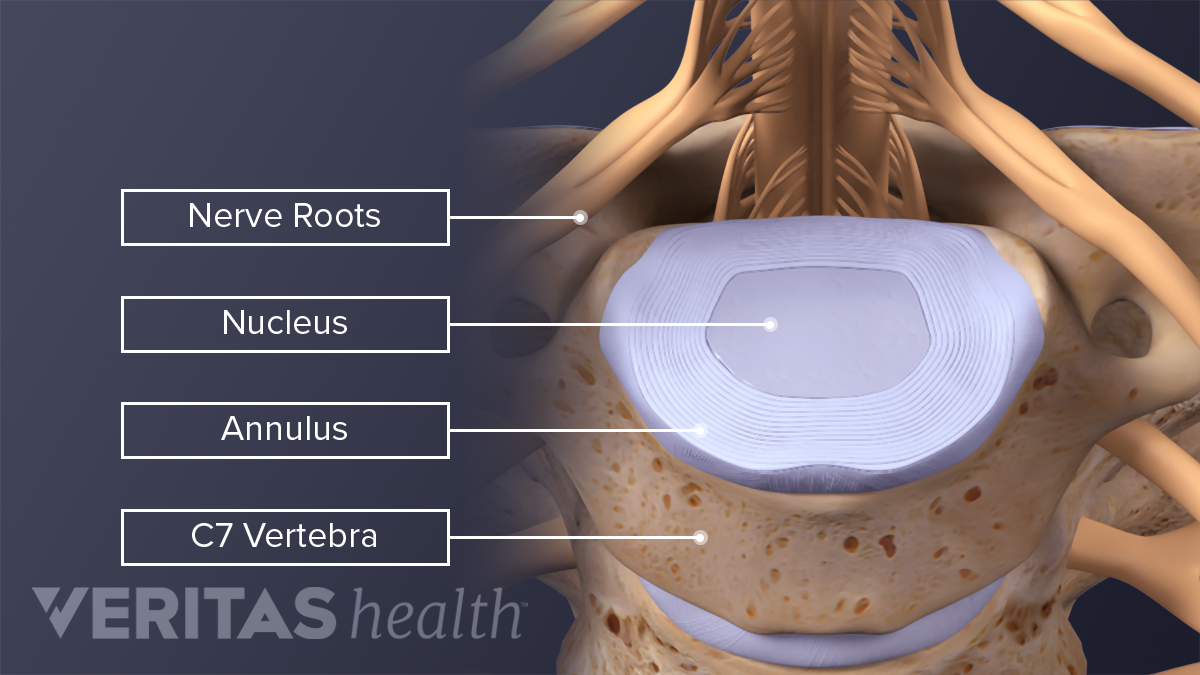 C6-C7椎节标记神经根，核，环，颈椎。