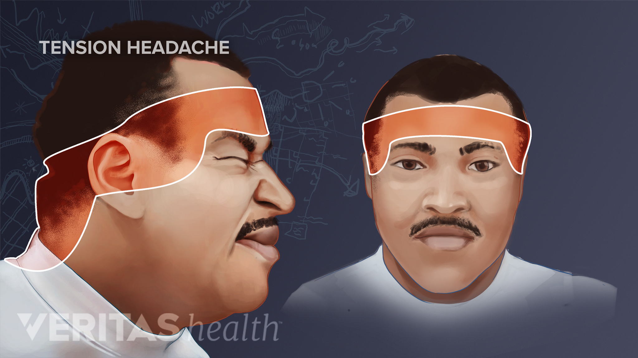 Profile and anterior view of the areas effected by a tension headache.