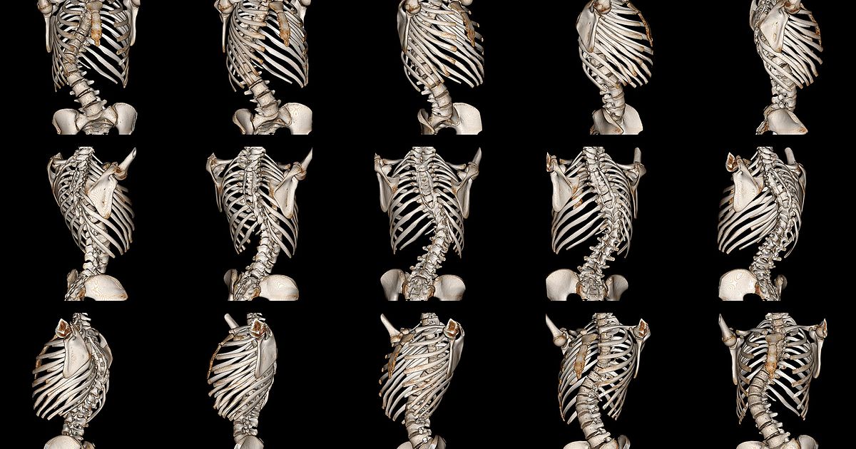 All About Degenerative Scoliosis