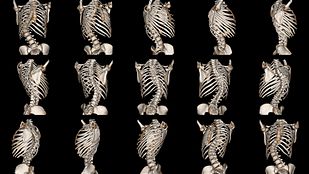 Scoliosis