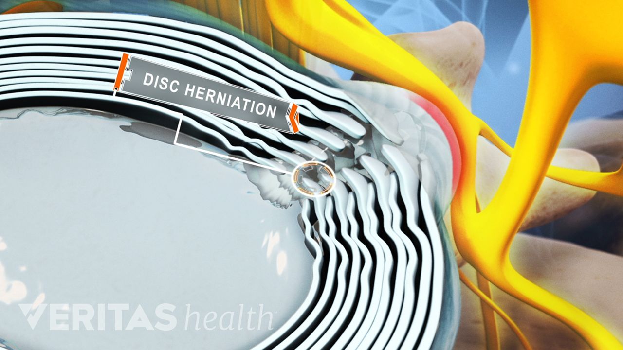 Full leakage of a herniated disc occurs when the disc nucleus pulposus breaches the outer layer of the annulus fibrosus.