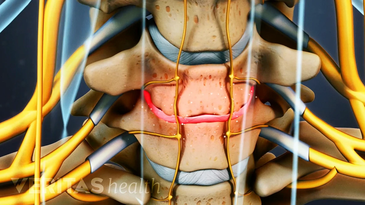 How Cervical Disc Degeneration Occurs