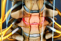 Cervical Stenosis with Myelopathy: Symptoms, Treatments, Surgery