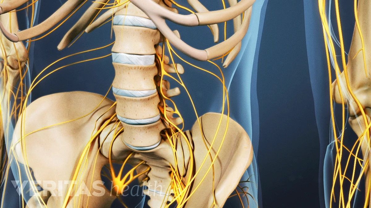 paquete Cien años Investigación Video sobre hernia de disco lumbar | Spine-health