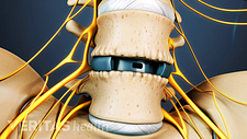 Posterior view of the lumbar spine with with an artificial disc.