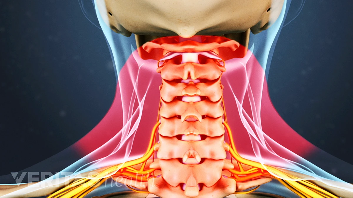 Signs You Should Seek a Doctor for Your Chronic Neck Pain