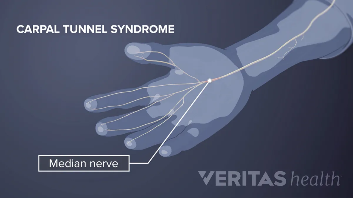 Carpal Tunnel Syndrome - AVALA