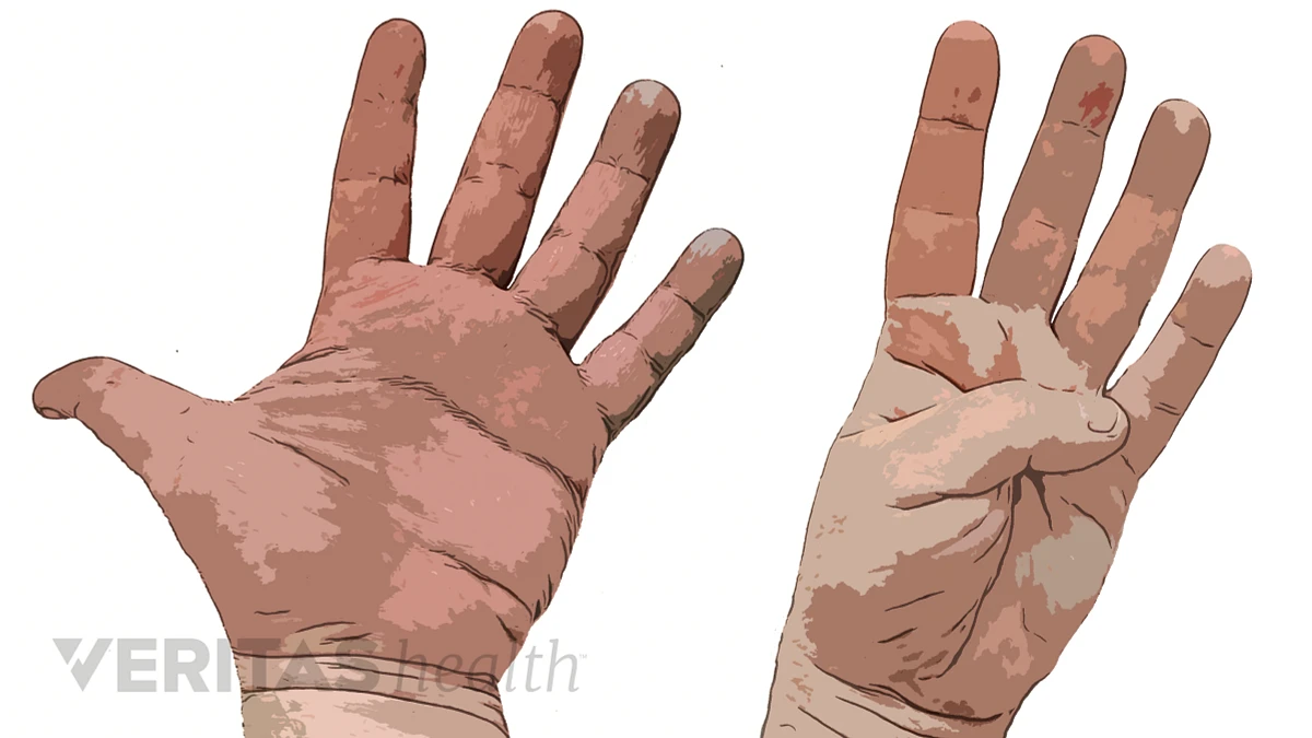 Dupuytren's contracture - Wikipedia