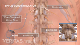 Medical illustration of an implanted generator for spinal cord stimulation