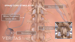 Medical illustration of an implanted generator for spinal cord stimulation