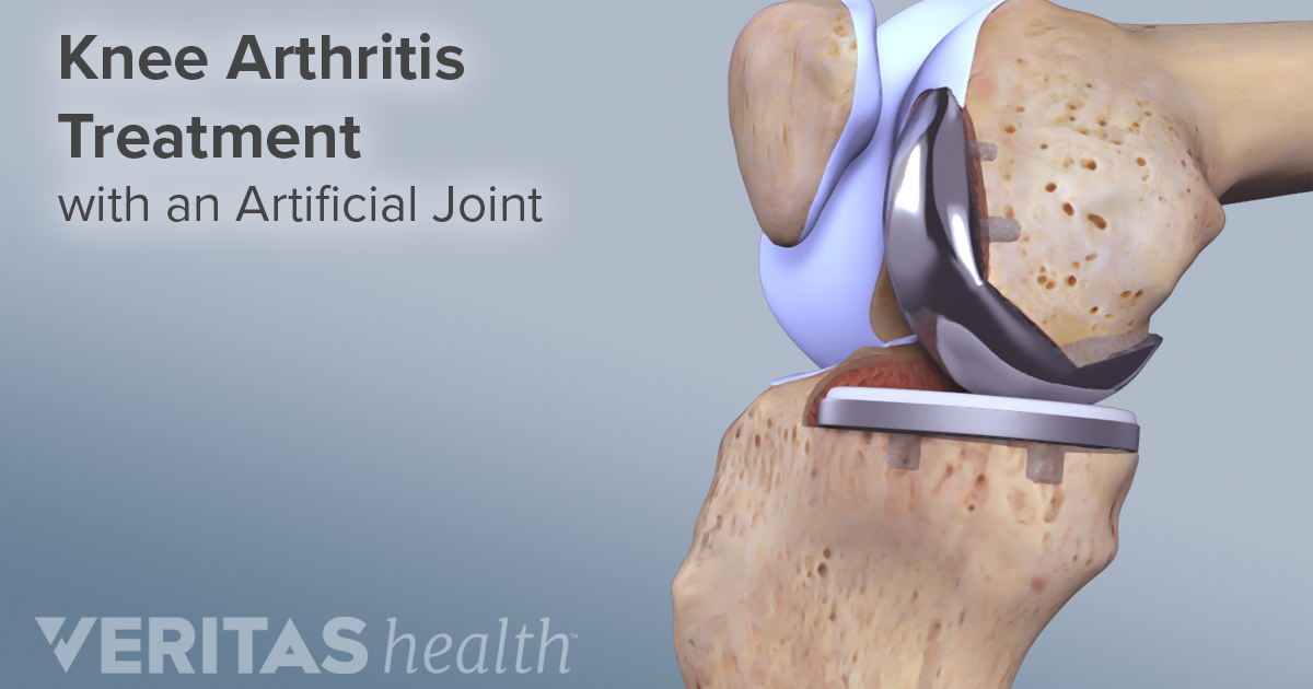 Total Knee Replacement Facts and Considerations for Patients