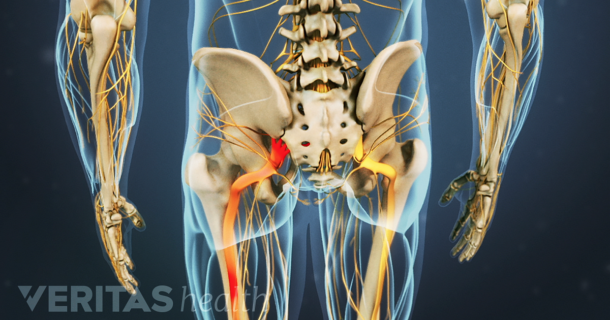 What Are The Signs Of Sciatic Nerve Damage?