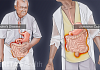Side by side comparison of Crohn's disease and ulcerative colitis