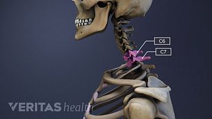 骷髅的头部、颈部和肩部的插图，突出显示了c6和c7椎体