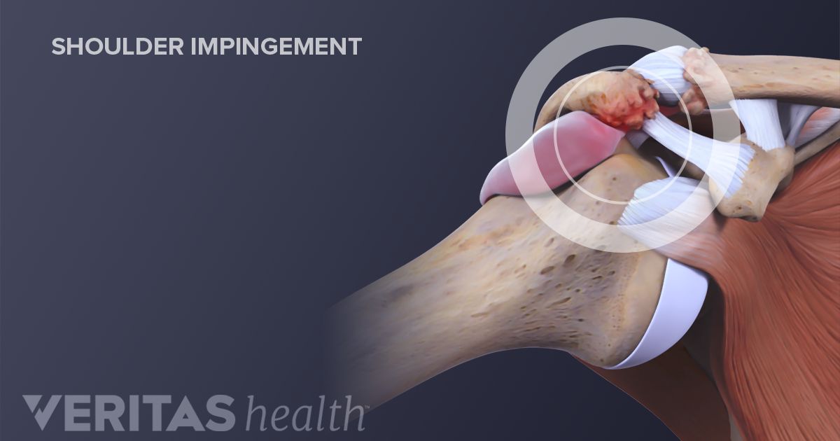 rotator cuff impingement surgery