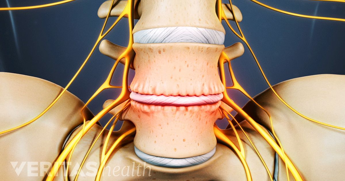 Síntomas De La Enfermedad Degenerativa De Disco Lumbar
