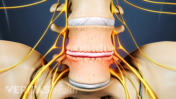 Study Finds 20% of Spine Fusion Patients Develop PTSD