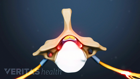 How Cervical Stenosis With Myelopathy Affects Your Body