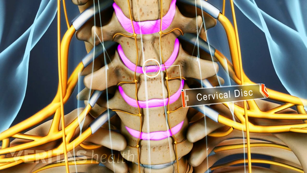 Radiculopatia cronica l4 l5 s1
