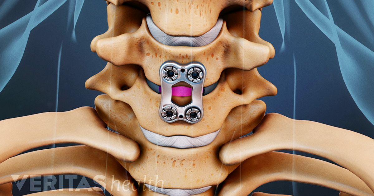 Potential Risks And Complications Of ACDF Surgery   Metal Plate Acdf 