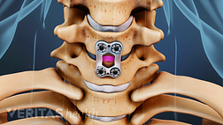 Anterior view of ACDF metal plate in the cervical spine.