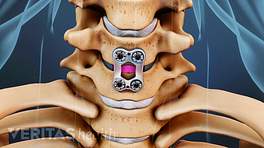 Medical illustration of the placement of a metal plate from ACDF surgery across two cervical vertebrae