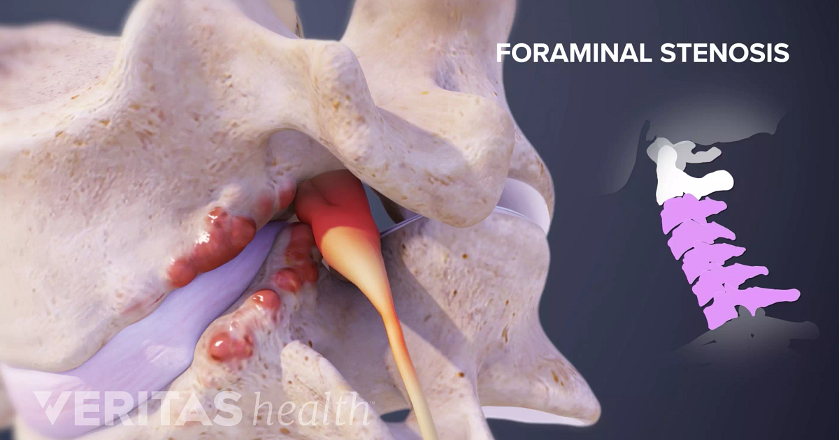 Neural Foraminal Stenosis Definition Back Pain And Neck Pain Medical Glossary