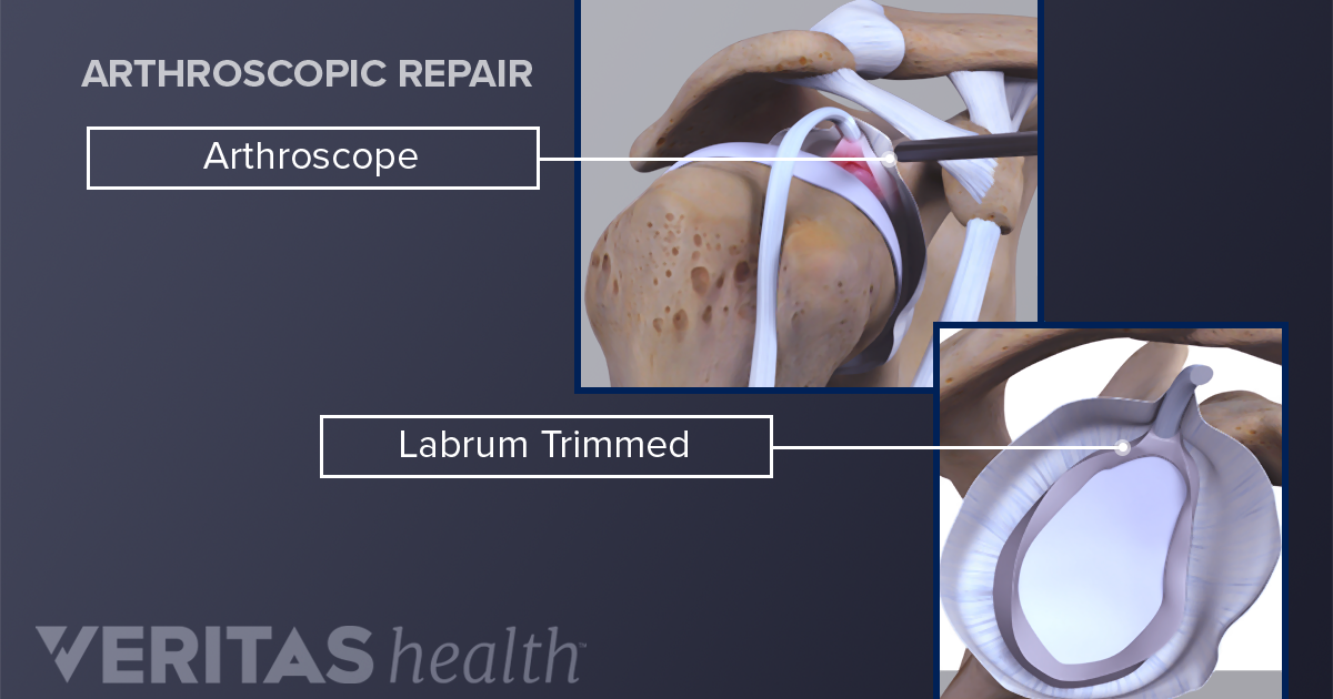 Labrum Tear Treatments