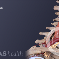 Profile view of the neck with scar tissue labeled in the thoracic spine.