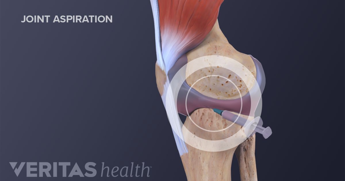 Arthrocentesis Definition | Defined by Arthritis-Health