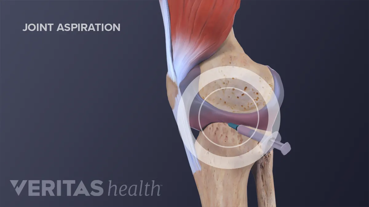 Hip joint replacement - series—Normal anatomy: MedlinePlus Medical  Encyclopedia
