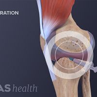 Side view of the knee showing swelling from ACL tear with a needle injected into the swelling.