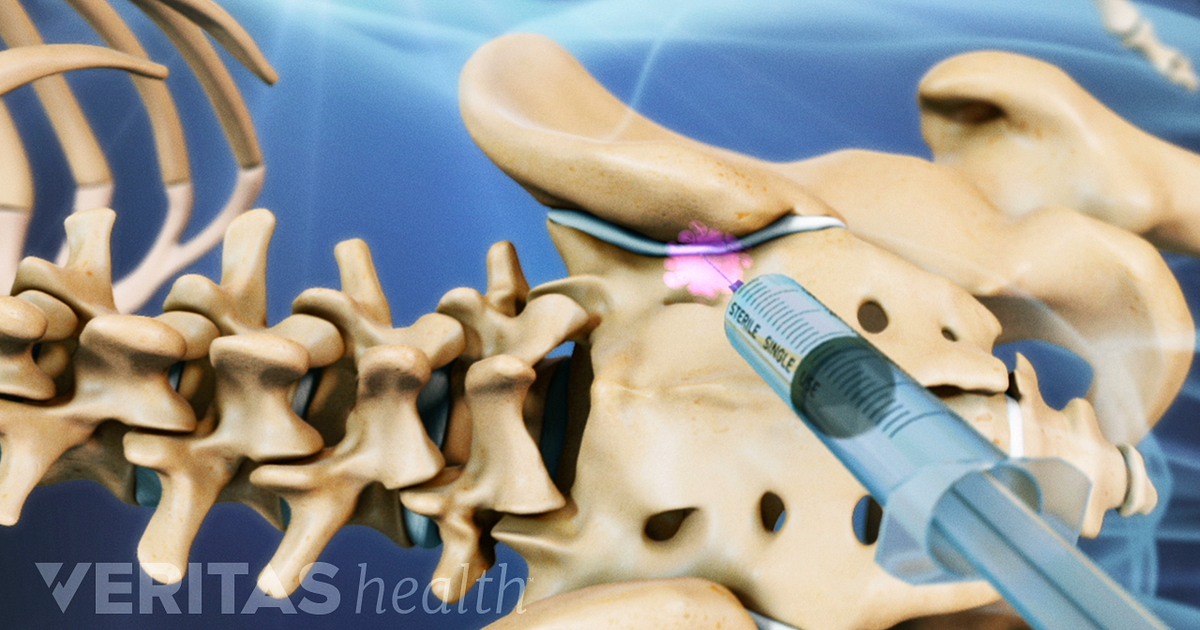 Lumbar Epidural Steroid Injections for Low Back Pain and Sciatica