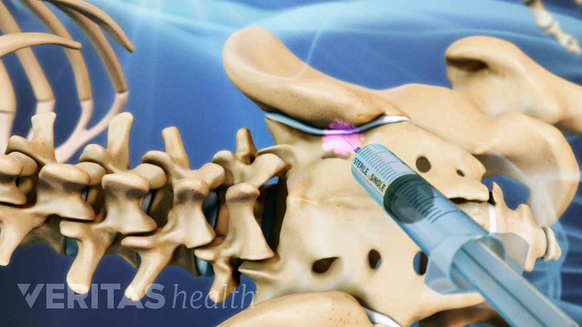 sacroiliac joint injection technique