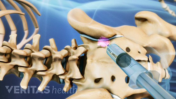 Understanding Sacroiliac Joint Injections