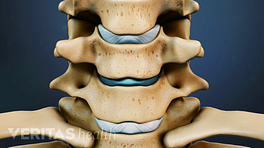 Anterior view of cervical spine showing disc replacement.