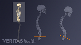 Profile views showing incorrect and correct spinal posture
