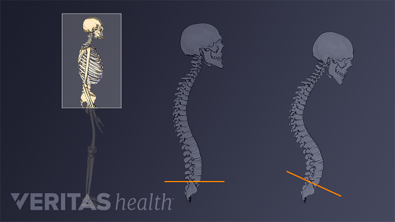 How your Pelvis and Head Position Play a Role in Keeping your Spine Healthy