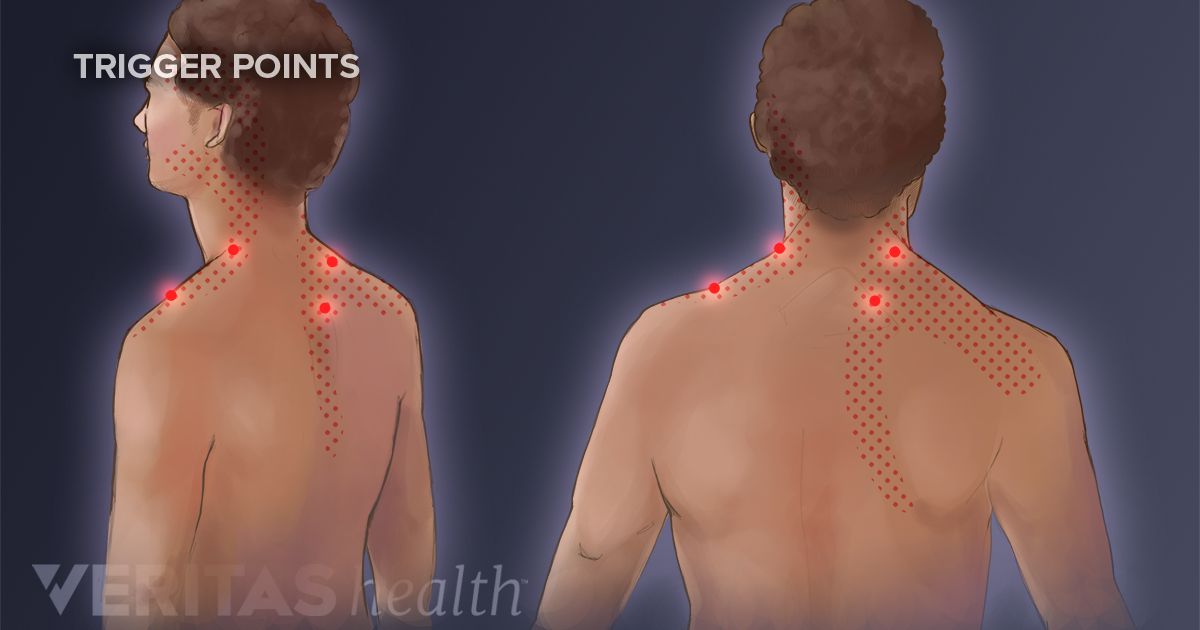 Trigger Point Myotherapy Definition | Back Pain and Neck Pain Medical ...