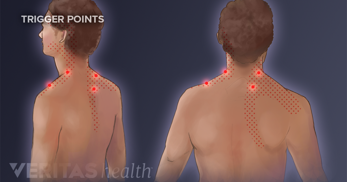Trigger Points Chart Neck