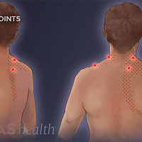 Posterior view of the upper body. Pain points highlighted in the neck, both shoulders, both elbows, and the lower back.