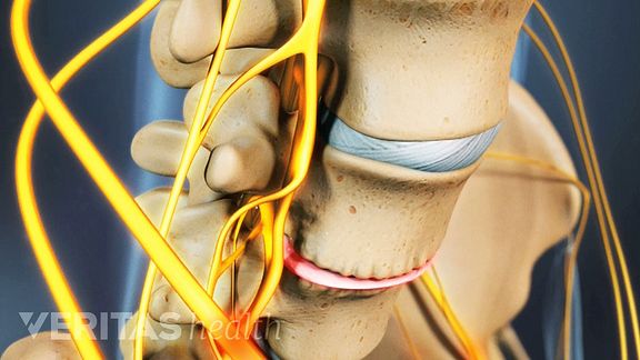 Lumbar osteophytes are bone spurs that grow in the low back due to degenerative changes.