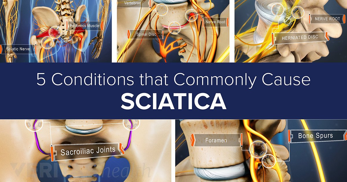 Slideshow 5 Conditions That Commonly Cause Sciatica